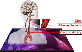Diagram of Atherosclerosis